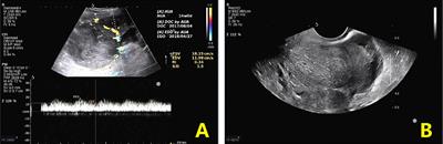Case Report: Stage IIIc primary malignant mixed Müllerian tumor of the fallopian tube: A case of 5-year disease-free survival after cytoreductive surgery combined with peritoneal resection and adjuvant chemotherapy with paclitaxel plus carboplatin